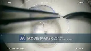 Ultra thin DSAEK - New time saving technique