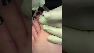 Infected Ingrown Toenail Removal