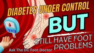 Diabetes Is Well Controlled, But Still Have Foot Problems