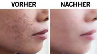 Wissenschafter haben 10 effektive Wege gegen Akne entdeckt!
