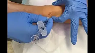 Ankle Joint - Intra-Articular Injection Technique