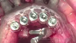 Guided Surgery with Neoss Tapered implant dr.A.Acocella dr.G.Ciabattoni