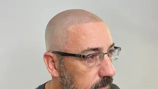 SMP Clients Reaction to Scalp Micropigmentation @MicropigmentationAcademy