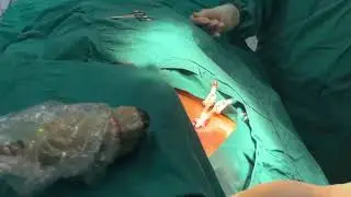 Palindrome Insertion Rt. IJV (Lateral approach) in Pacemaker  implantation patient.