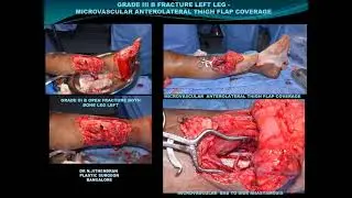 Both Bone Leg Bilateral Foot Crush Injury - Dr.Jitendran