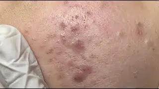 Inflammatory acne on cheeks #HoangMySpa105