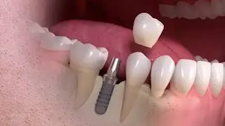 Kas yra danties implantas
