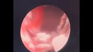 mini nephroscope guidewire tunnel coagulation