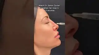 Watch Dr. Simon straighten a patient's nose in 15 seconds