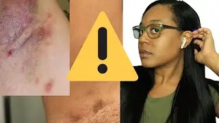 Don’t watch if you get grossed out fast! Hidradenitis Suppurativa! Fighting HS! Cyn Doll
