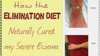 How the Elimination Diet Naturally Cured My Severe Eczema