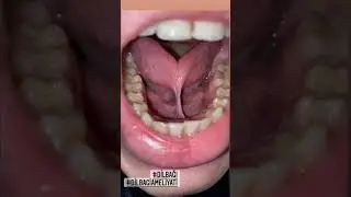 Dilbağı,tongue tie,ankyloglossia