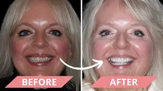 Joan Sees Her New Smile For The First Time