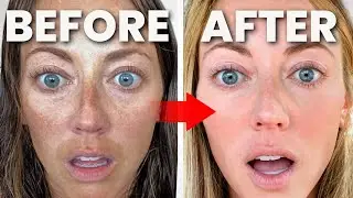 HOW TO GET RID OF HYPERPIGMENTATION, MELASMA, DARK SPOTS, SUN SPOTS, POST-INFLAMMATORY ERYTHEM