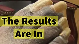 The Results Are In: Treatment And Lab Results For Thick Fungal Toenails