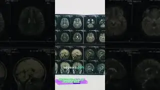 Decoding Brain MRI  Understanding T1 and T2 W #earlydetection #digitalradiography #cancerawareness