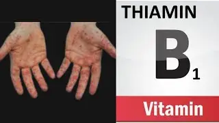 Vitamin B1 (Thiamine) deficiency symptoms, food sources and benefits of the B1 vitamin