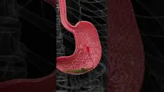 🔴 Understanding Bleeding Gastric Ulcers: A Serious Health Condition 🔴