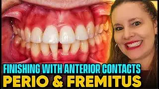 Anterior Contacts, Fremitus, Root Resorption and Perio