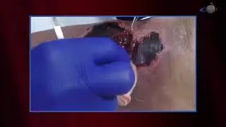WCW: Debriding a Lower Leg Traumatic Hematoma