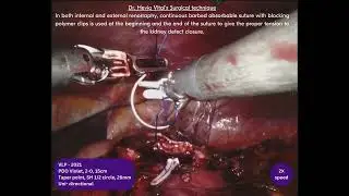 Robotic Partial Nephrectomy by Dr. Vital Hevia
