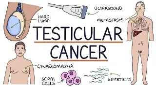 Understanding Testicular Cancer