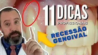 Recessão gengival: 11 Dicas Profissionais para prevenir e parar retração de gengiva