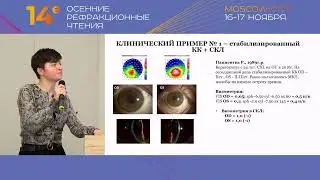 Реабилитационные возможности склеральных контактных линз при индуцированных аметропиях
