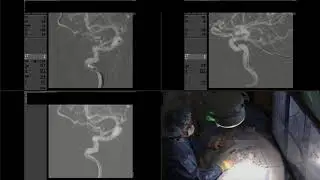 Ruptured dural AVF with cortical venous drainage treated with onyx