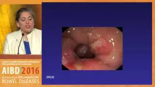 What are the common mimics of ulcerative colitis and Crohn's disease?