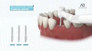 Имплантаты AB Dental