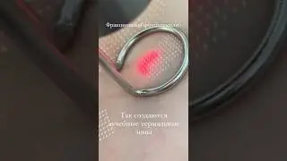 Что делает лазер?#гинекология #доктор #недержаниемочи #laserco2 #психология #москва #топ #жена