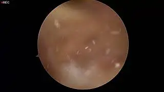 Pembersihan Kesan Gout di lutut, Gout Operation at Knee. Part 3