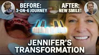3 on 6 Dental Implants: A Real Patient’s Experience with More Natural Dental Implants 