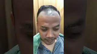 Full Senyum  #hairsystem #barbershop #toupeepria #hairstyle #toupee #haircut #hairreplacement