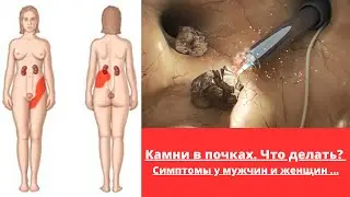 Камни в почках - без операции....