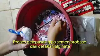 Pencetakan Gips Untuk Gigi Palsu