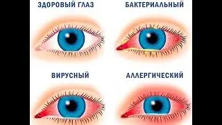 Как ставить пиявки на глаза.