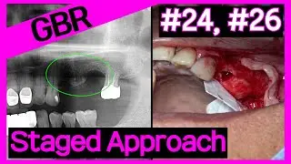 [Online Surgery] #24, #26 GBR First