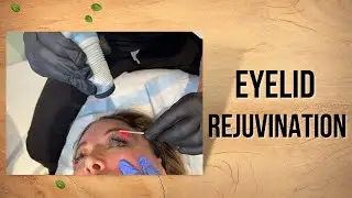 GET TIGHT BRIGHT EYES WITH CO2 LASER | Dr. Jason Emer