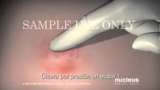 Úlceras por presión