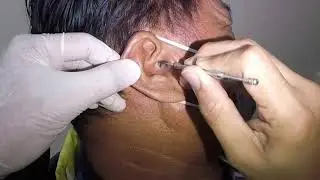 Removing Huge Earwax Stuck in Man