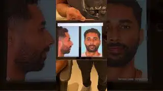 Male rhinoplasty 2 months post-op | Anthony Bared MD, FACS | Miami, FL