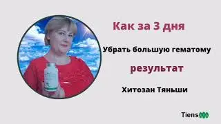 Как за 3 дня убрать большую гематому. Результат Хитозан. Тяньши .           #Тиенс#Tiens#Тяньши