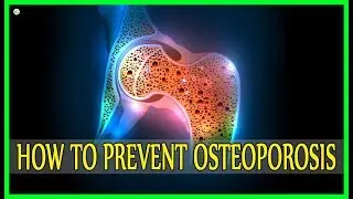 7 Ways To Help Prevent Osteoporosis (Bone Loss) - Osteoporosis Prevention
