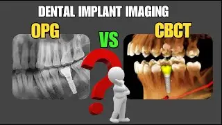 Radiographic Imaging for dental implant |CBCT for Dental implant