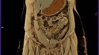 Colitis with Cinematic Rendering