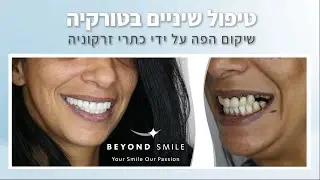 טיפול שיניים בטורקיה - שיקום מושלם בפה על ידי כתרי זרקוניה