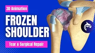 Frozen Shoulder (Adhesive Capsulitis)
