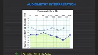 AUDIOGRAM INTERPRETATION